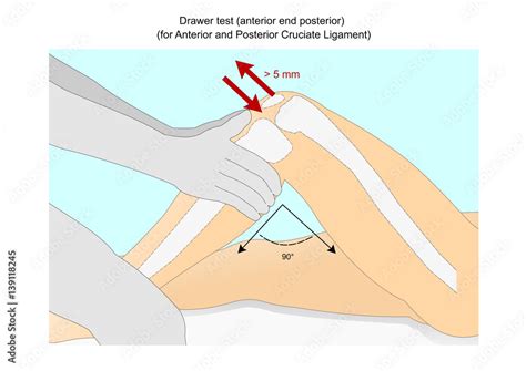 anterior drawer test vs posterior